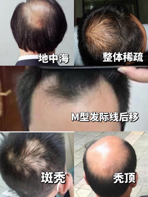 爱心假发：为脱发群体带来自信与慰藉，意义究竟何在？
