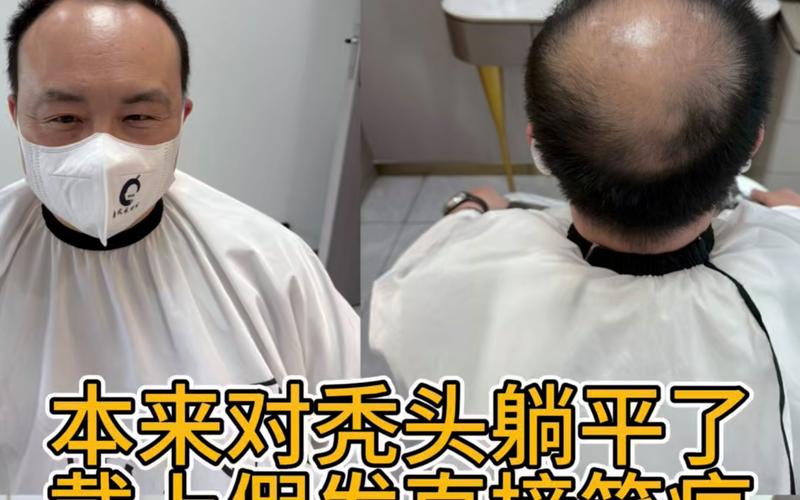 爱心假发：源于各界捐赠，给予脱发者慰藉与信心