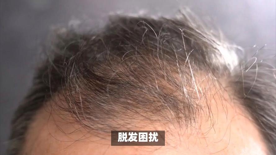 爱心假发暖人心，为脱发群体重拾自信，勇敢面对生活